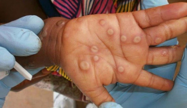 Ghana-records-5-monkey-pox-cases.jpg